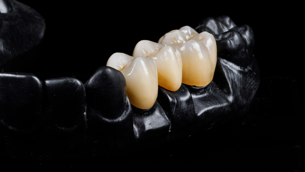 falls-dental-lab-inc_Service_crown-and-bridge