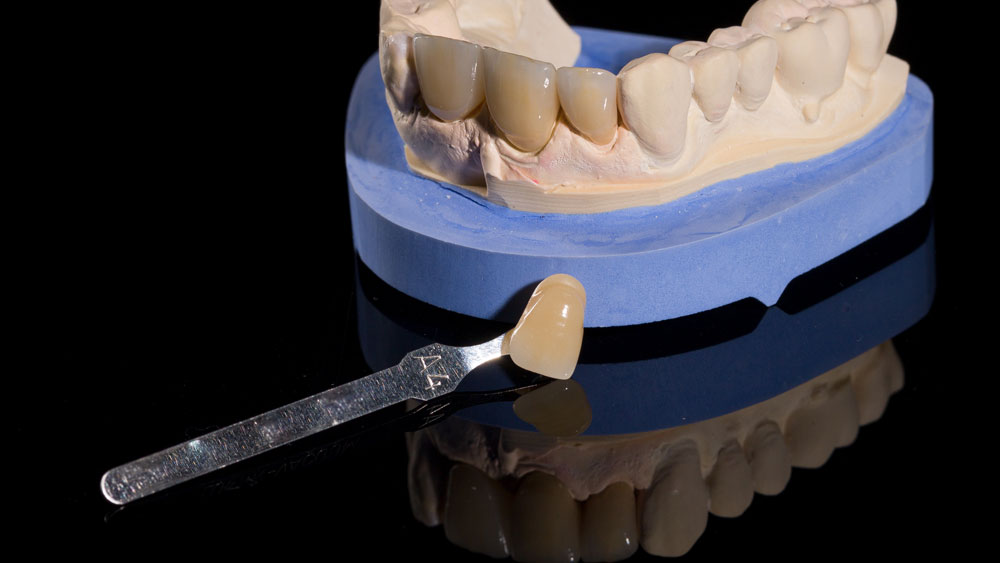 falls-dental-lab-inc_Service_custom-shades