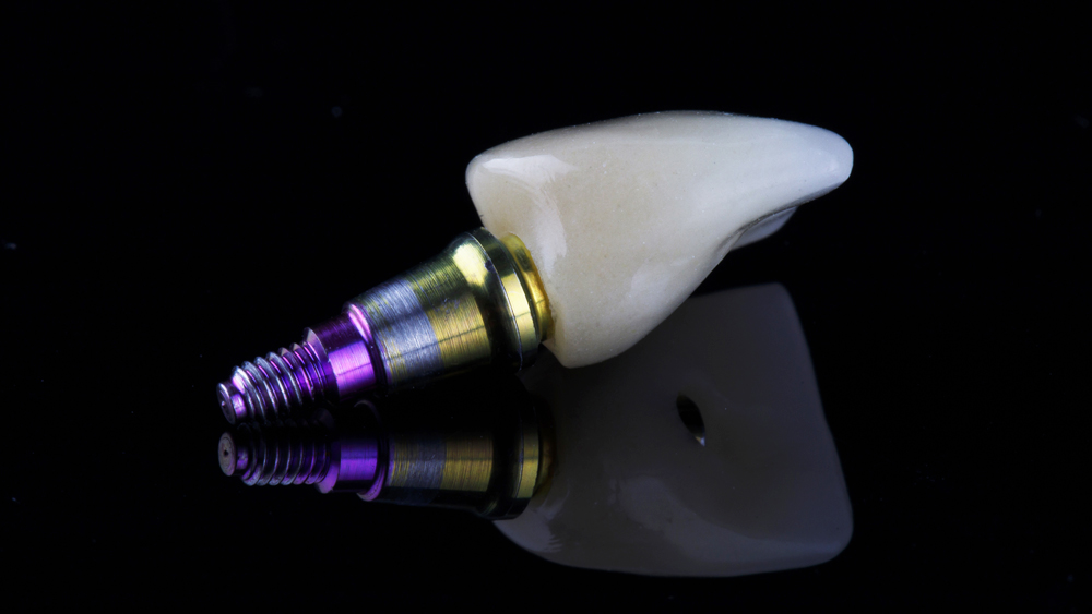 falls-dental-lab-inc_Service_implants